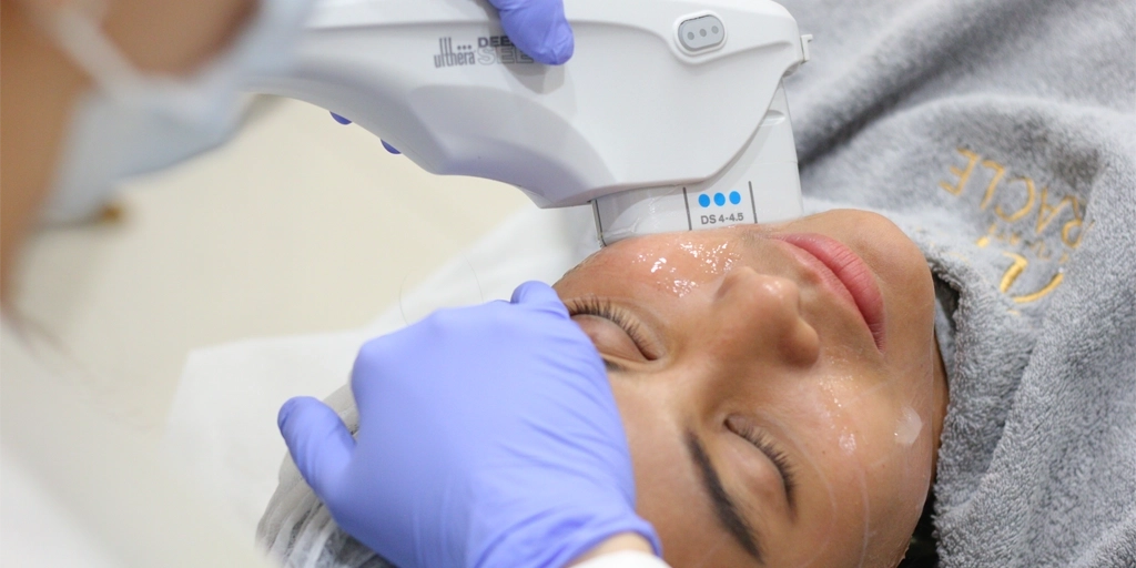 Ultherapy Preventive Aging sebelum 40